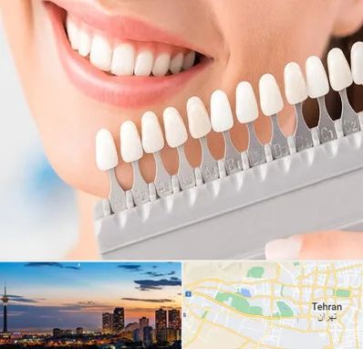 متخصص لمینت دندان در غرب تهران 