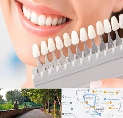 متخصص لمینت دندان در فلکه گاز رشت