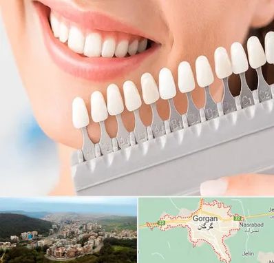 متخصص لمینت دندان در گرگان