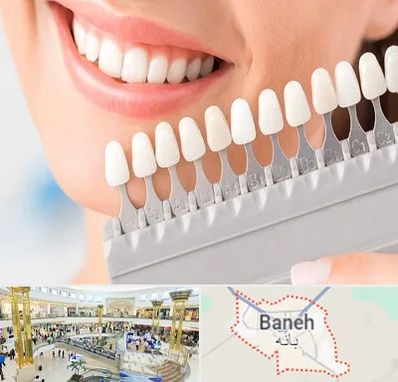 متخصص لمینت دندان در بانه
