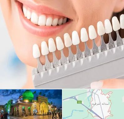 متخصص لمینت دندان در آستانه اشرفیه