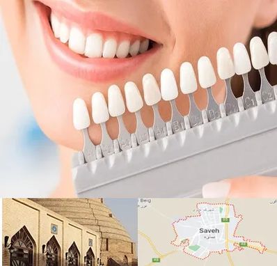 متخصص لمینت دندان در ساوه