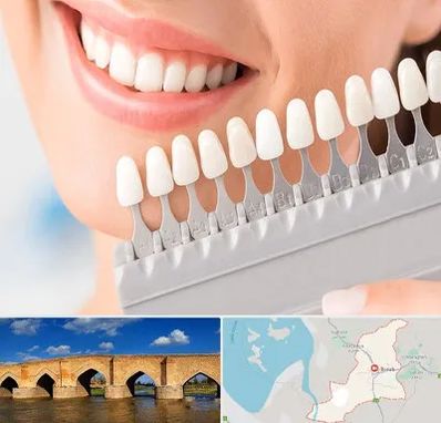 متخصص لمینت دندان در بناب