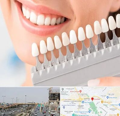 متخصص لمینت دندان در بلوار توس مشهد