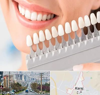 متخصص لمینت دندان در گوهردشت کرج 