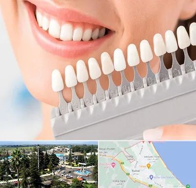 متخصص لمینت دندان در رودسر