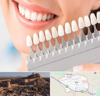متخصص لمینت دندان در بم