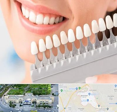 متخصص لمینت دندان در نسیم شهر