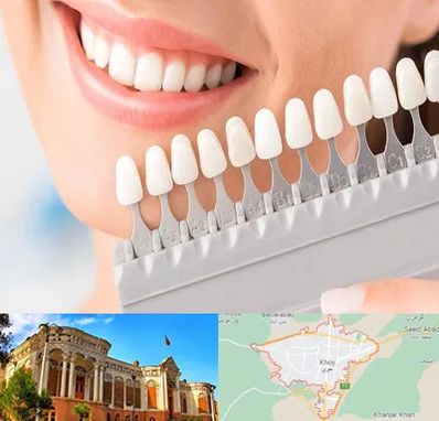 متخصص لمینت دندان در خوی