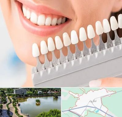 متخصص لمینت دندان در لنگرود