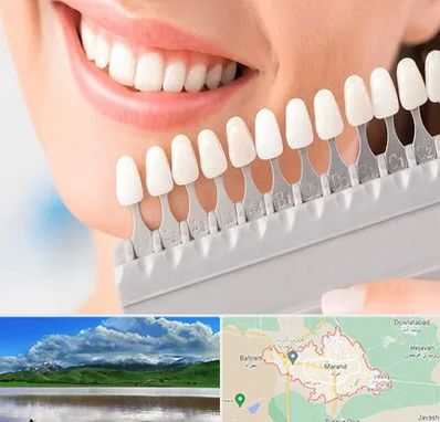 متخصص لمینت دندان در مرند