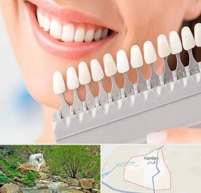 متخصص لمینت دندان در کردان