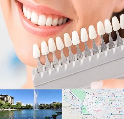 متخصص لمینت دندان در کوهسنگی مشهد