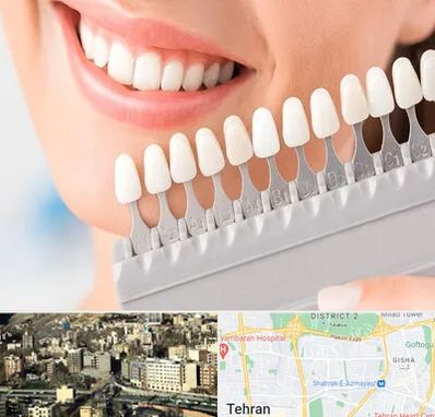 متخصص لمینت دندان در مرزداران 