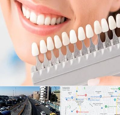 متخصص لمینت دندان در پیروزی 