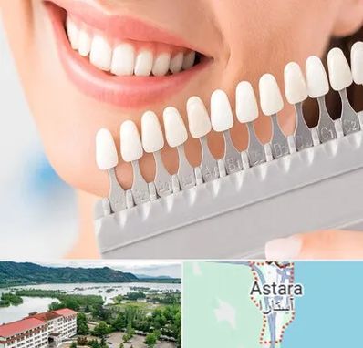متخصص لمینت دندان در آستارا