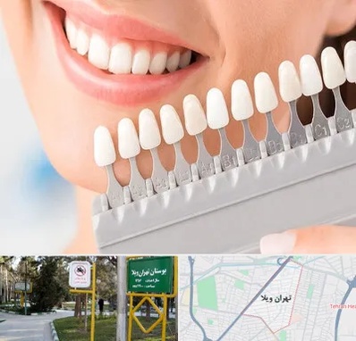 متخصص لمینت دندان در تهران ویلا