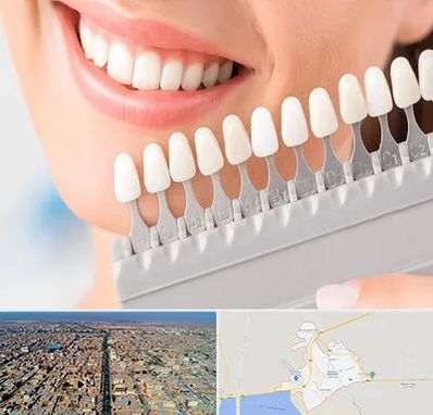 متخصص لمینت دندان در بندر ماهشهر