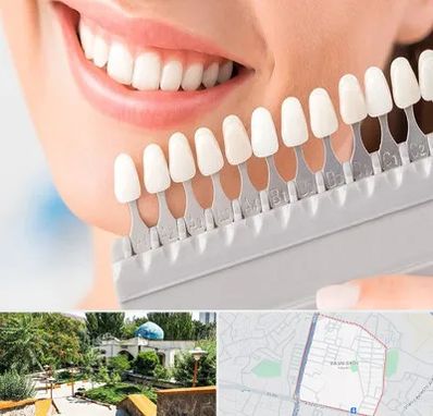 متخصص لمینت دندان در باغمیشه تبریز