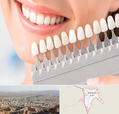 متخصص لمینت دندان در اسفراین
