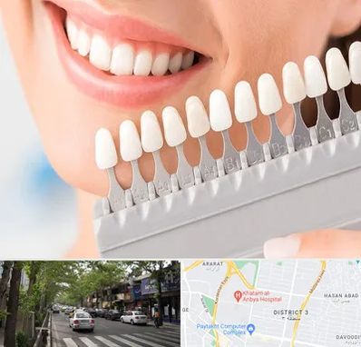 متخصص لمینت دندان در ظفر 