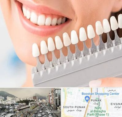 متخصص لمینت دندان در پونک 