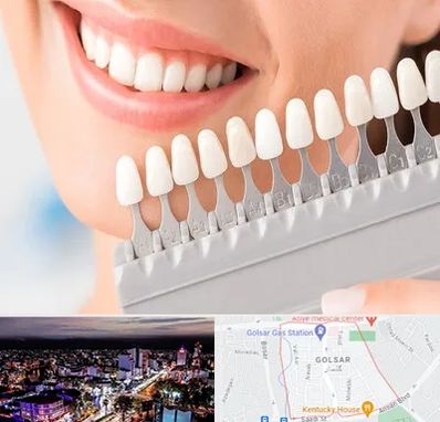 متخصص لمینت دندان در گلسار رشت 