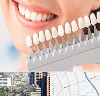 متخصص لمینت دندان در خیابان بهشتی