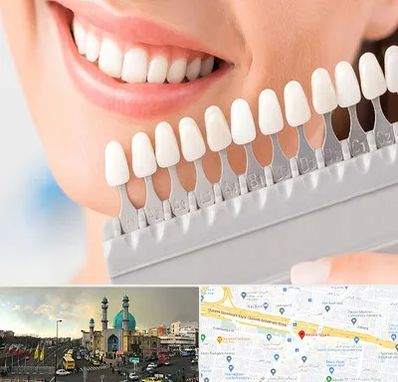 متخصص لمینت دندان در رسالت