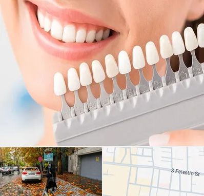 متخصص لمینت دندان در خیابان فلسطین