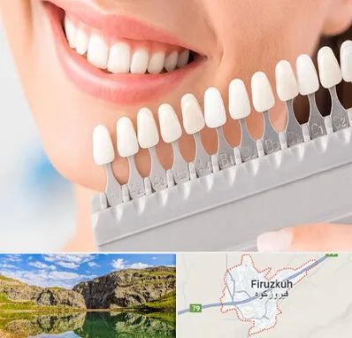 متخصص لمینت دندان در فیروزکوه