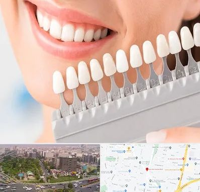 متخصص لمینت دندان در آیت الله کاشانی