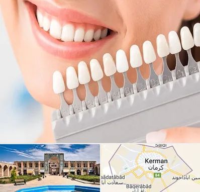 متخصص لمینت دندان در کرمان