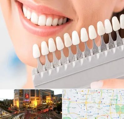 متخصص لمینت دندان در جنت آباد تهران 