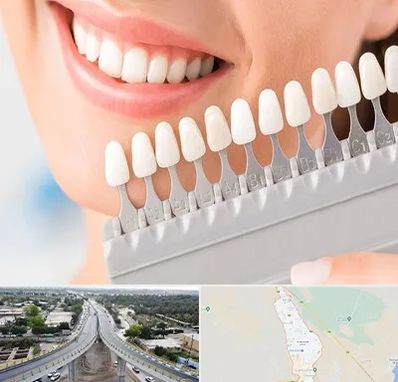 متخصص لمینت دندان در اندیمشک