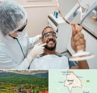 ایمپلنت فوری در آمل