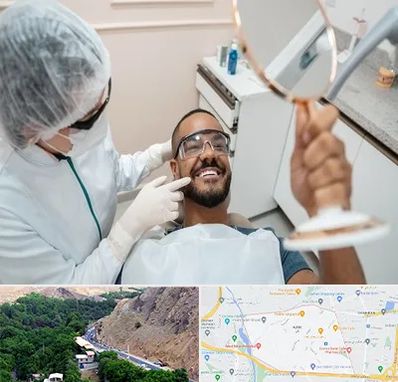 ایمپلنت فوری در کن