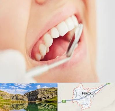 اصلاح طرح لبخند در فیروزکوه