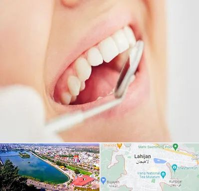 اصلاح طرح لبخند در لاهیجان