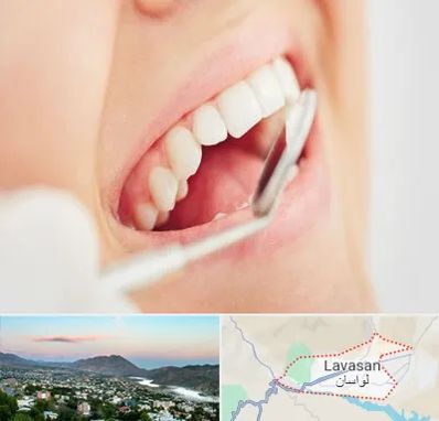 اصلاح طرح لبخند در لواسان