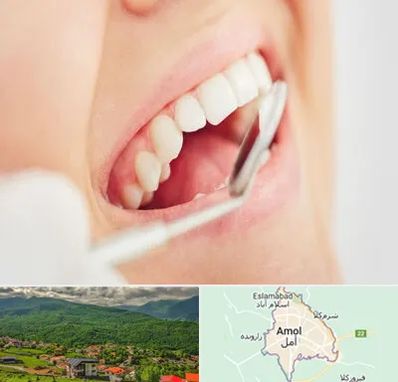 اصلاح طرح لبخند در آمل