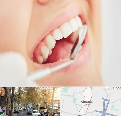 اصلاح طرح لبخند در کاشانک