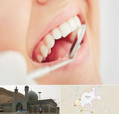 اصلاح طرح لبخند در شهرضا