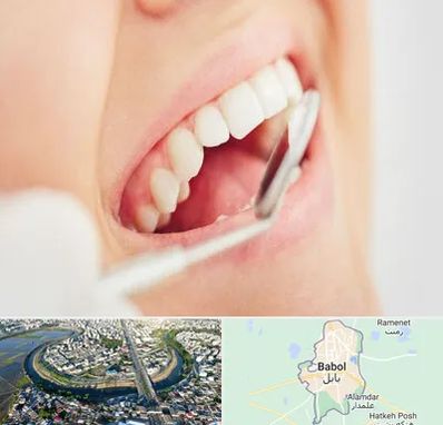 اصلاح طرح لبخند در بابل