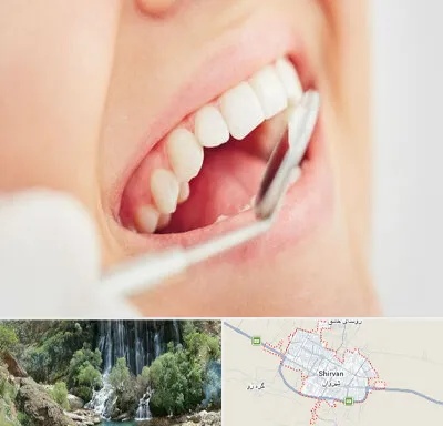 اصلاح طرح لبخند در شیروان