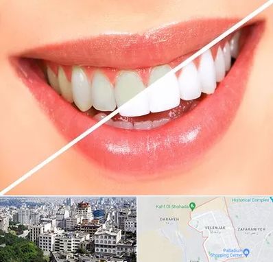 بلیچینگ دندان در ولنجک 