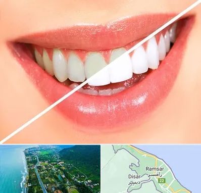 بلیچینگ دندان در رامسر