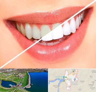 بلیچینگ دندان در مهاباد