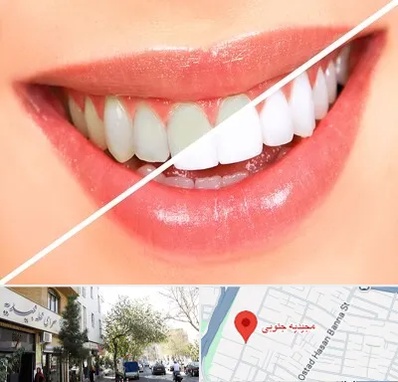 بلیچینگ دندان در مجیدیه جنوبی