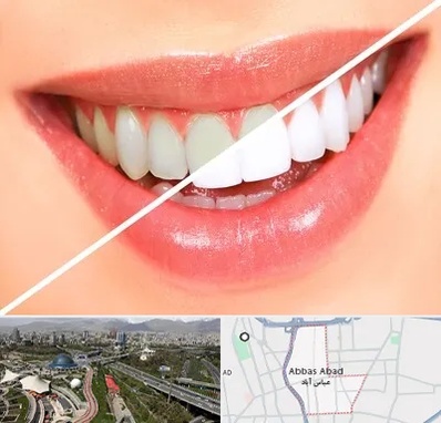 بلیچینگ دندان در عباس آباد تهران
